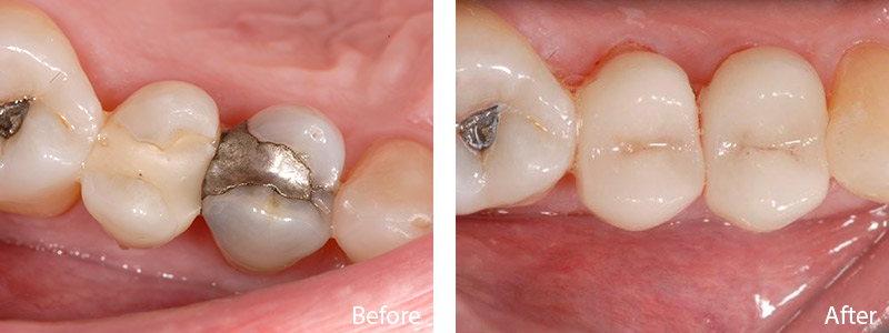 William B. had a metallic silver and composite filling replaced with a tooth-colored CEREC filling.