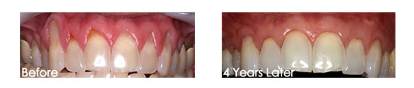 before and after one