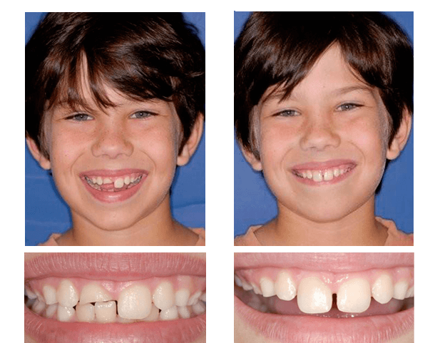 Daniel W. was playing with his little brother and a play bat they were using hit him in the face and fractured his front tooth. Dr. Schulz fixed his smile using a CEREC restoration.