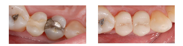William B. had a metallic silver and composite filling replaced with a tooth-colored CEREC filling