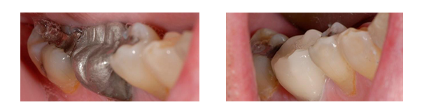 This patient had a large amalgram filling replaced using CEREC technology.