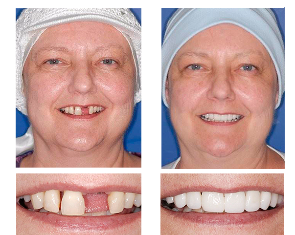 Lucinda P. had severe dental issues as a result of chemotherapy. After a dental implant and CEREC porcelain veneers, Lucinda’s smile is better than ever.