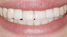 Clip-On+Veneers ... front teeth. They were fixed in a single visit with CEREC veneers