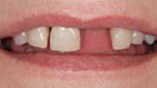 Clip-On+Veneers ... and CEREC porcelain veneers, Lucinda’s smile is better than ever
