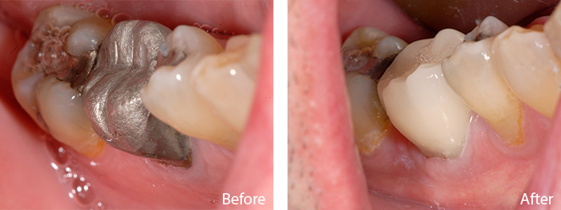 William B. had a metallic silver and composite filling replaced with a tooth-colored CEREC filling.