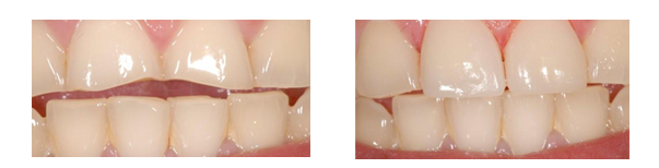 Maria was a patient seen by Dr. Schulz while on a goodwill medical mission with the US government. She had ground down her front teeth, and Dr. Schulz replaced them using CEREC Veneers and Laser therapy.