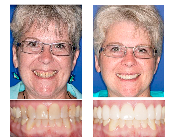 Gwen W. got veneers on her upper teeth, brightening and evening out her smile.