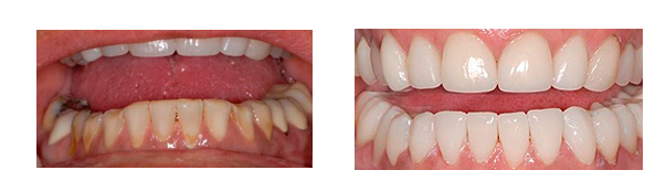 Arlene M. had the lower arch rehabilitation with CEREC.