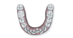 Overly crowded teeth