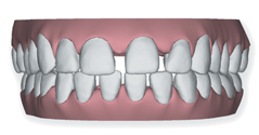 Widely spaced teeth